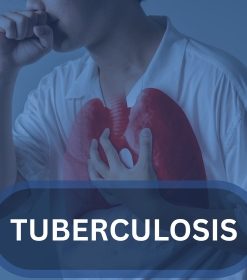 Tuberculosis